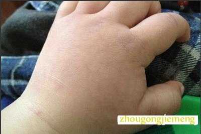 梦见患手肿