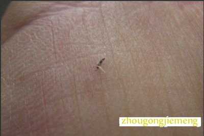 梦见被木刺刺了